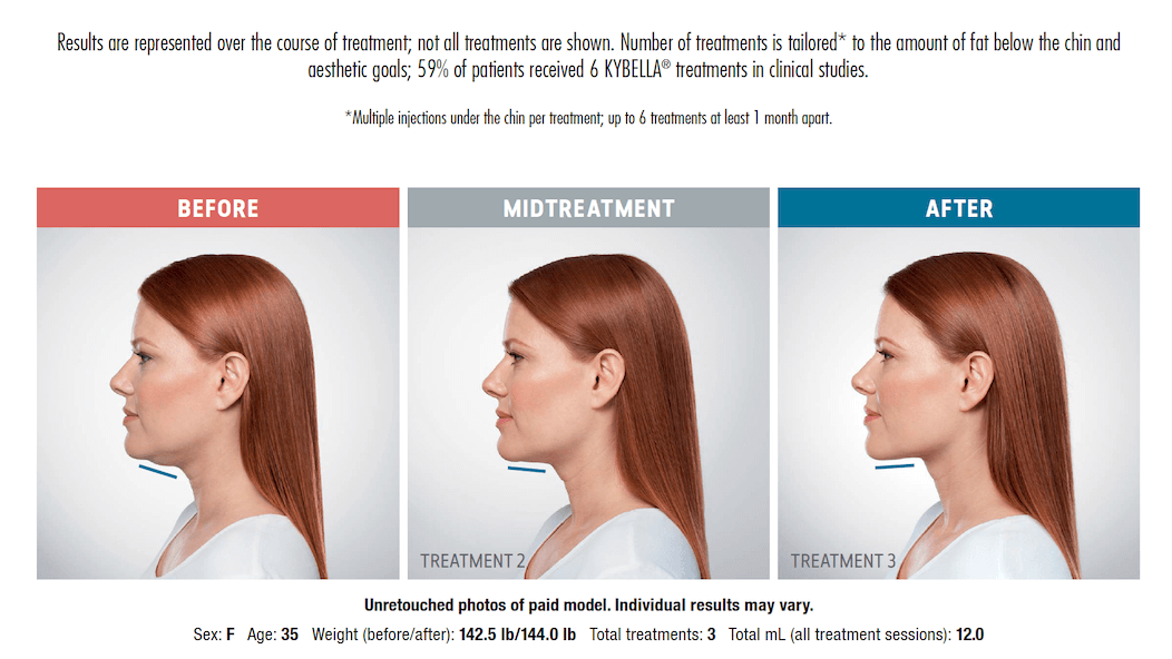 Kybella before and after treat
